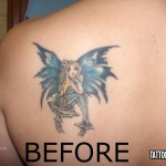 Birmingham Tattoo Removal Services